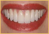 Teeth Bonding Pat-2 Image