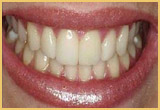 Before And After Teeth Bonding Image